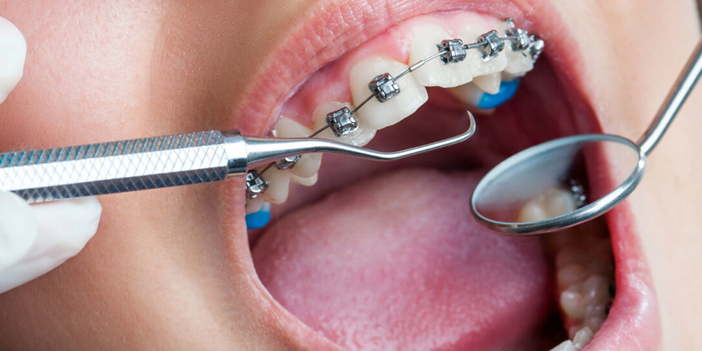 Ortodontik sorunlar öz güven problemlerine yol açabiliyor