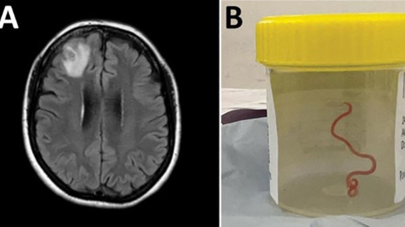 Dünyada ilk: Avustralya'da bir hastanın beyninden canlı solucan çıkarıldı