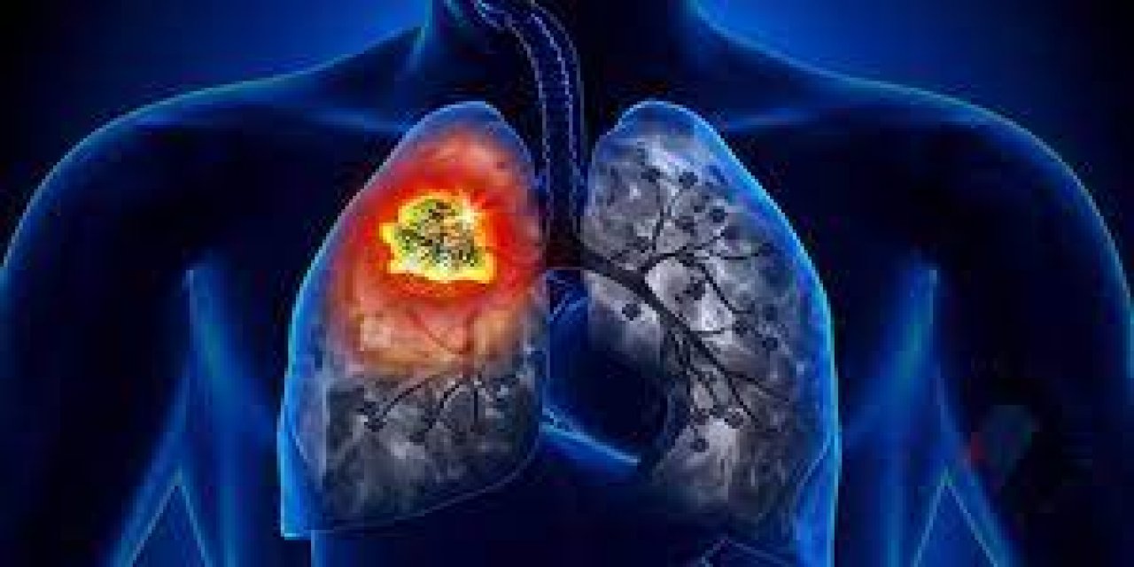 Dünyada en çok ölüme kanser akciğer kanseri