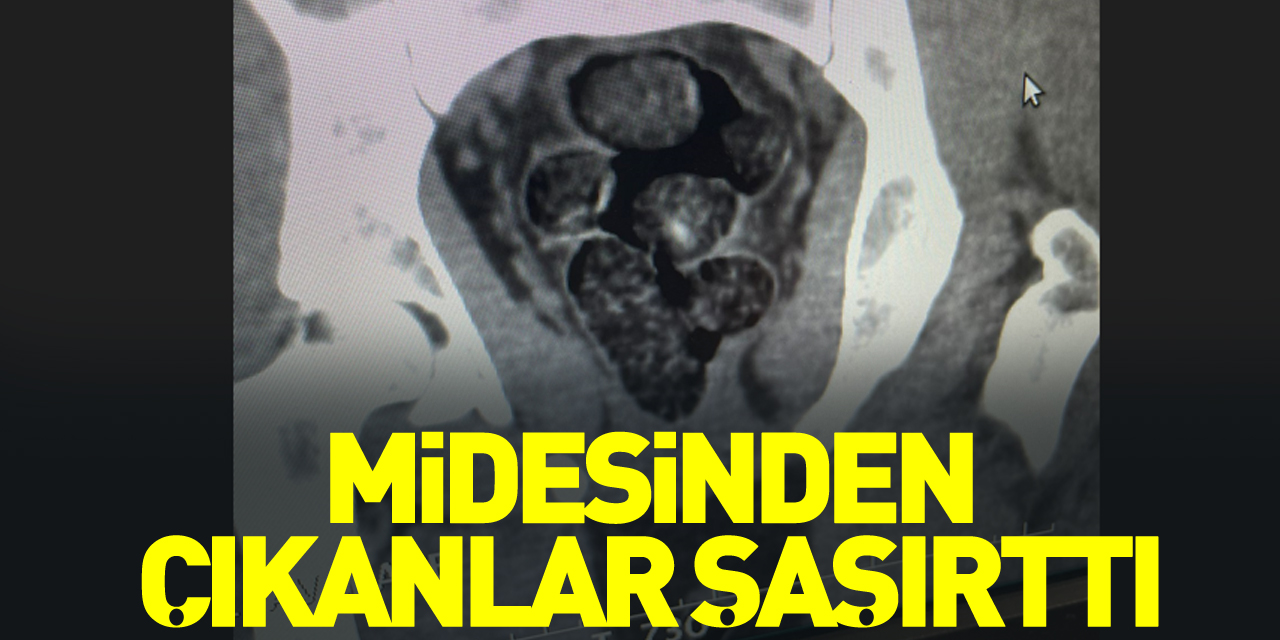 Midesinden çıkanlar şaşırttı