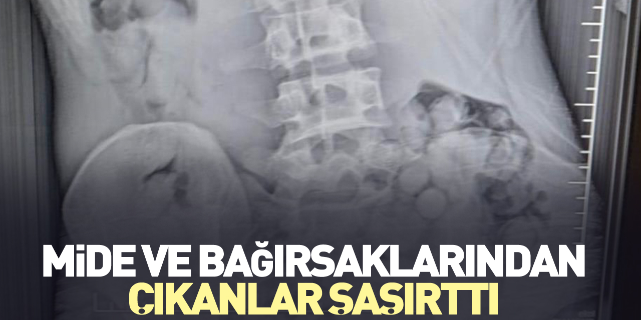 Mide ve bağırsaklarından çıkanlar şaşırttı