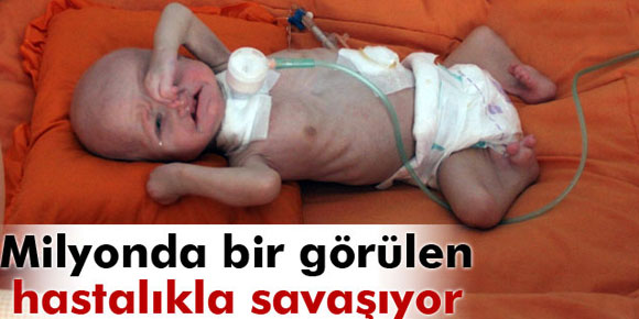 Minik Mustafa milyonda bir görülen hastalıkla savaşıyor