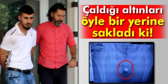 Çaldığı ziynet eşyaları röntgende ortaya çıktı