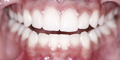 Diş etindeki renklenmeler hastalık belirtisi olabilir