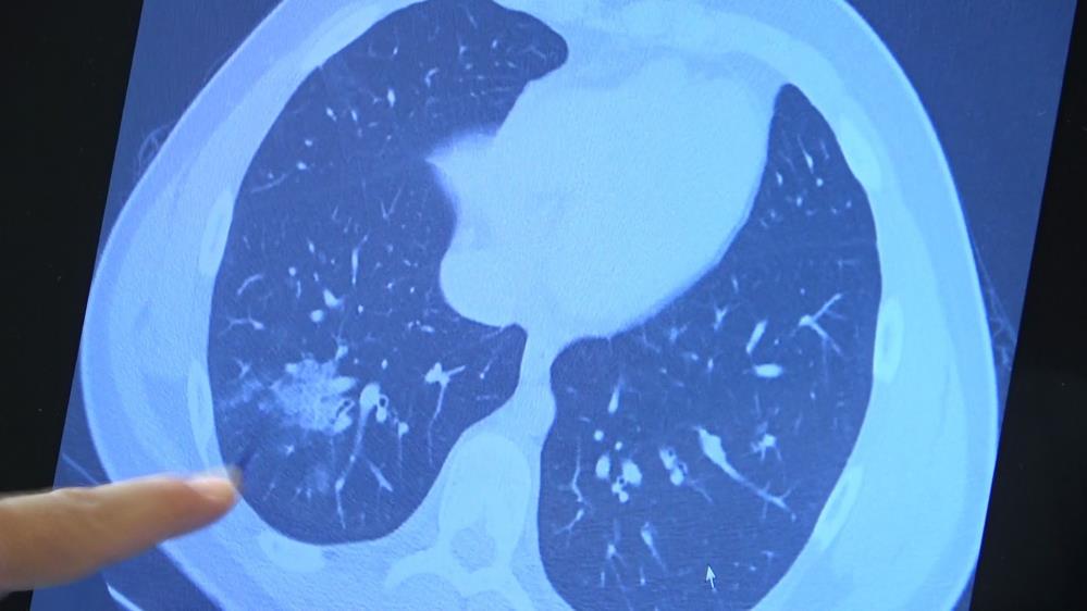 Aşı olmayan 14 yaşındaki çocukta ciddi akciğer tutulumları görüldü  