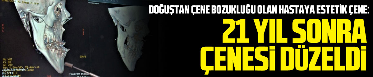 Doğuştan çene bozukluğu olan hastaya estetik çene: 21 yıl sonra çenesi düzeldi