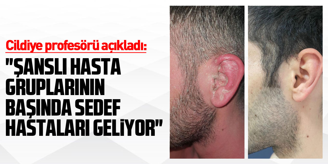 Cildiye profesörü açıkladı: "Artık günümüzde şanslı hasta gruplarının başında sedef hastaları geliyor"